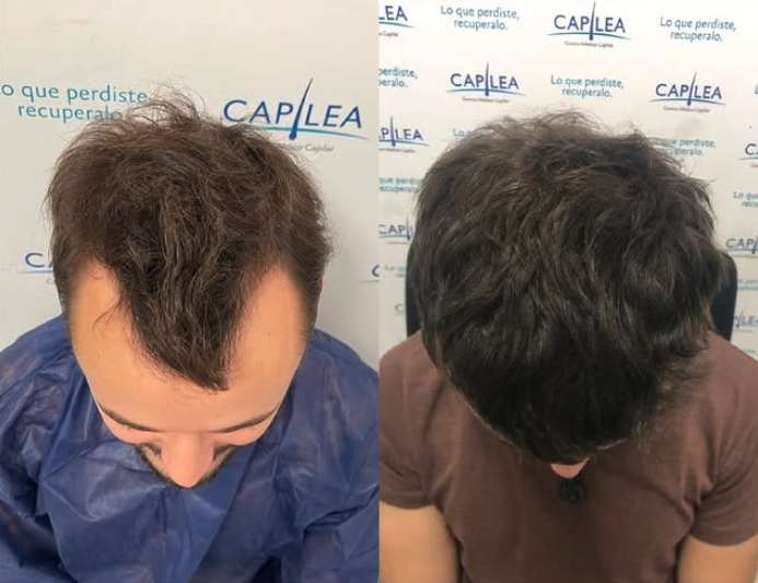 resultados de un implante capilar