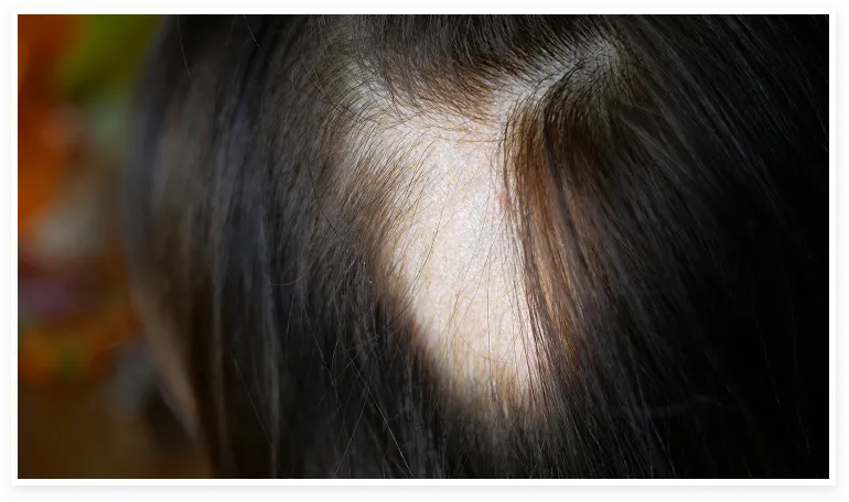 Cabeza de una persona con alopecia areata